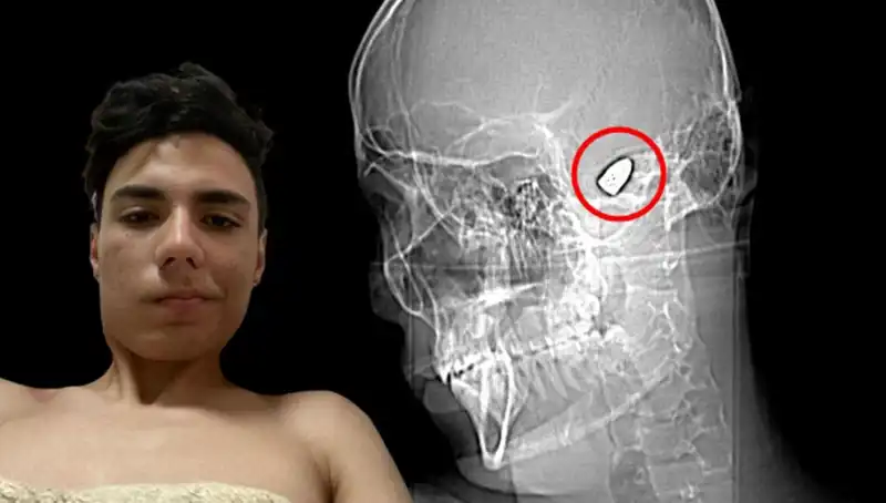 Kafasında Patlayıcı Var: Hayatı Tehlikede Olan Genç Adamın Hikayesi